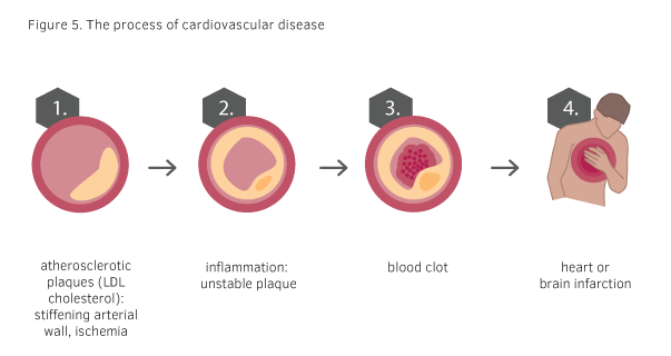 Beer and Cardiovascular Disease - Beer and Health