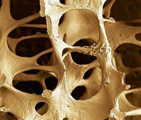 More research needed on alcohol and osteoporosis