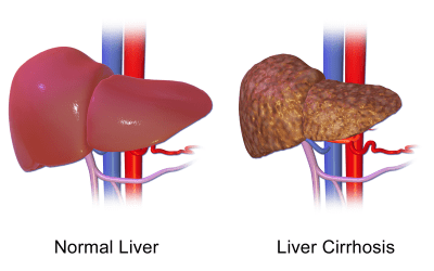 Meta-analysis: women drinking alcohol at higher risk for liver cirrhosis compared to men