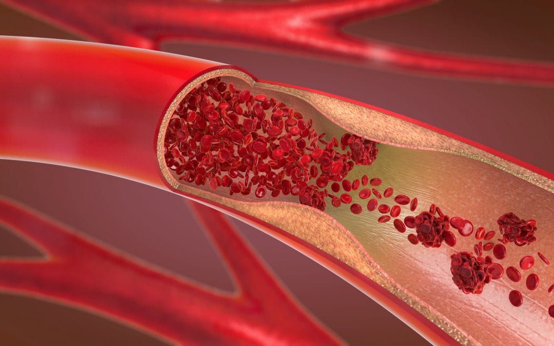 Association between alcohol and venous thromboembolism not clear yet